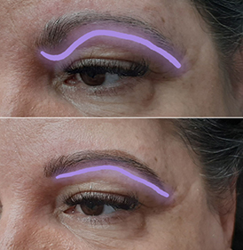 Eyebrow Correction
